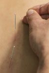 Dry needling treatment by physiotherapy in zirakpur vip road